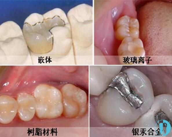 超详细嵌体和高嵌体区别及收费介绍,想补牙的人看过来