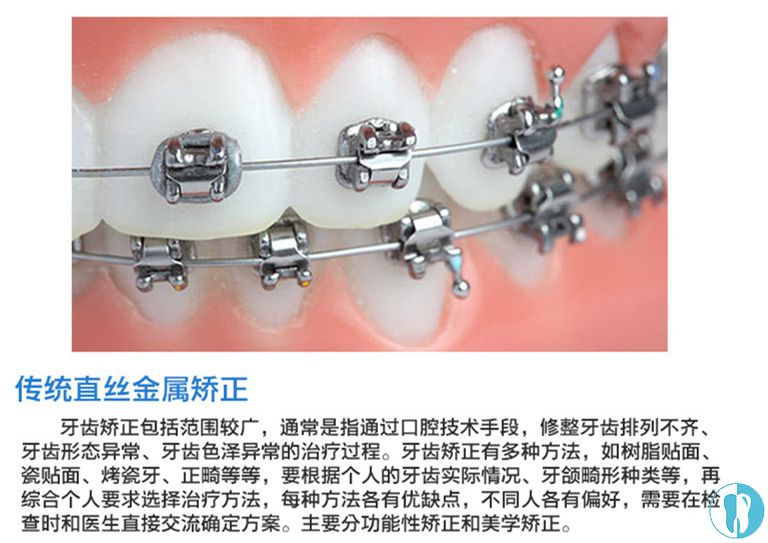 传统金属矫正器图片