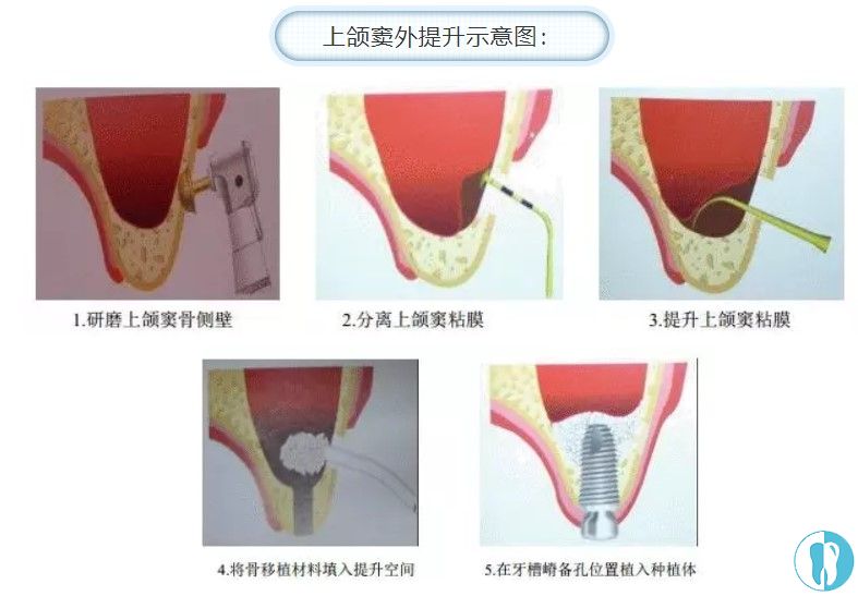 上颌窦外提升图示