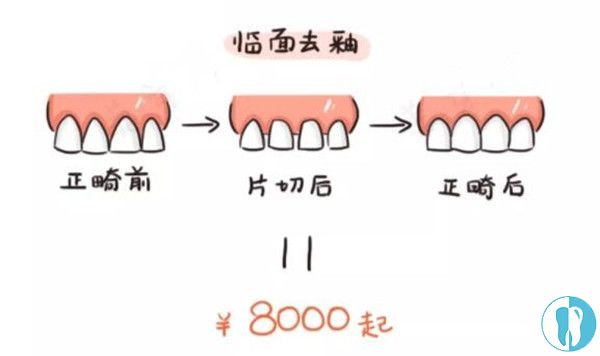 拿什么拯救牙齿黑三角是片切矫正好还是瓷贴面好