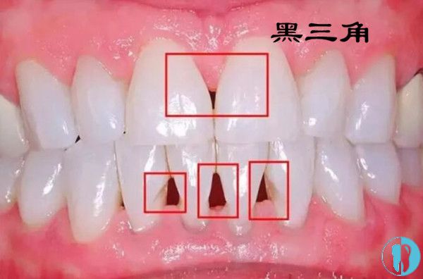 拿什么拯救牙齿黑三角?是片切矫正好还是瓷贴面好