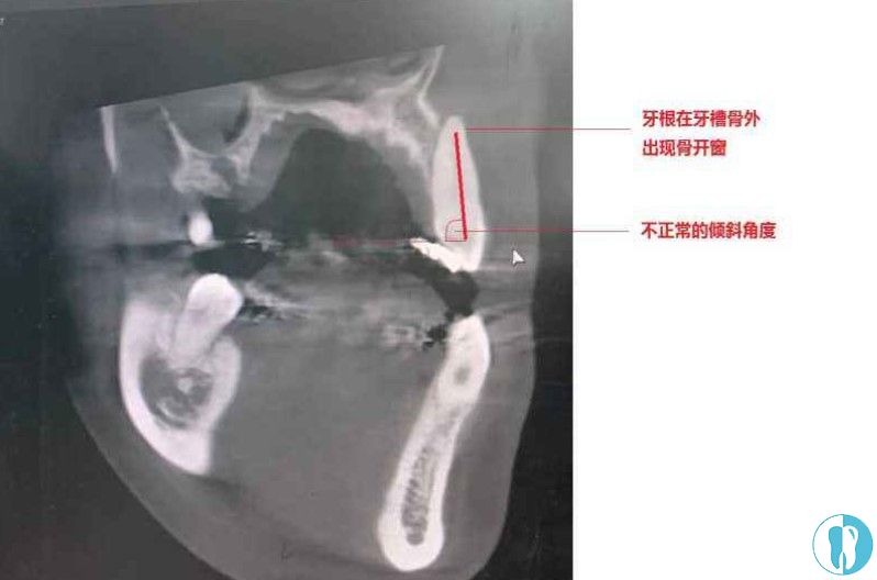 矫正中出现骨开窗或骨开裂的情况