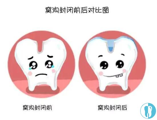 预防蛀牙千万不要错过儿童窝沟封闭和涂氟的黄金年龄