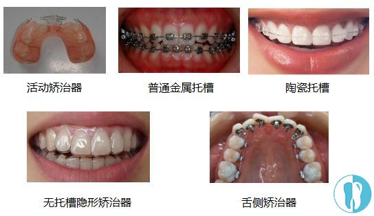 矫正牙套的种类那么多,隐形牙套和钢丝牙套价格差多少