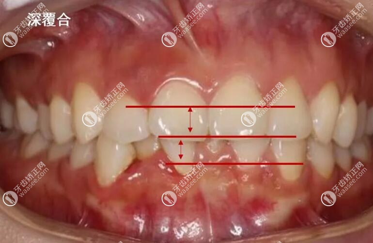 深覆合几度怎么看的？这有深覆合一度二度三度照片供参考 口腔资讯 牙齿矫正网