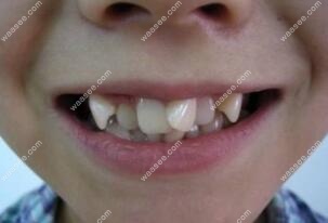 小孩子在乳牙期基本没有龅牙,但是长大了换牙后很多小孩就会出现龅牙