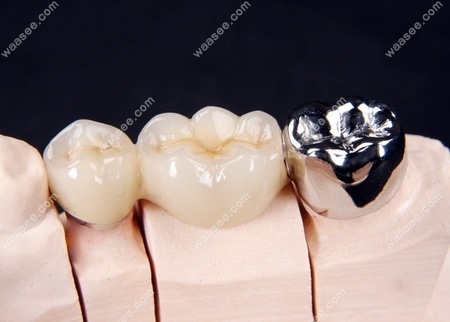 牙医科普纯钛金属牙冠的优缺点附价格分享哦