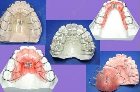 乳牙反颌矫正器种类图片