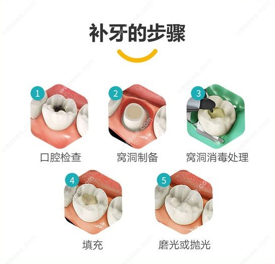 补牙的流程及步骤图片