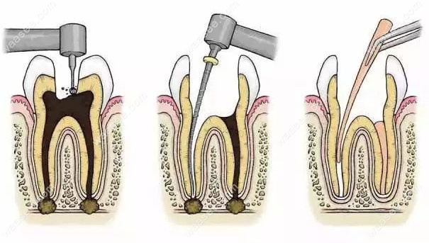 根管治疗的哪些步骤能使牙齿寿命延长这些知识告诉你